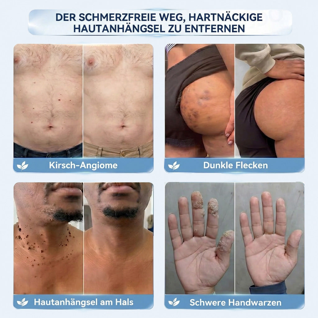 𝐇𝐢𝐬𝐤𝐢𝐧®  2-in-1 Advanced schmerzfreie narbenfreie Hautreparaturcreme – gegen Hautwucherungen, Warzen und sichtbare Hautmakel