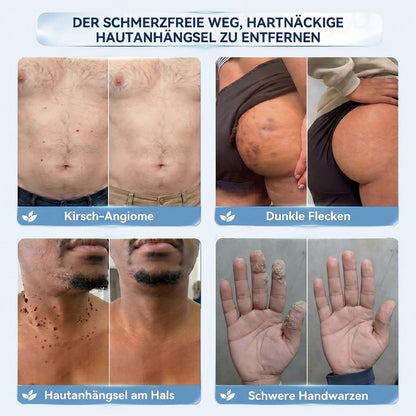 𝐇𝐢𝐬𝐤𝐢𝐧®  2-in-1 Advanced schmerzfreie narbenfreie Hautreparaturcreme – gegen Hautwucherungen, Warzen und sichtbare Hautmakel