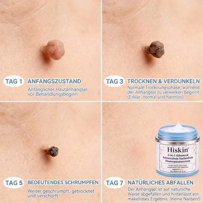 𝐇𝐢𝐬𝐤𝐢𝐧®  2-in-1 Advanced schmerzfreie narbenfreie Hautreparaturcreme – gegen Hautwucherungen, Warzen und sichtbare Hautmakel