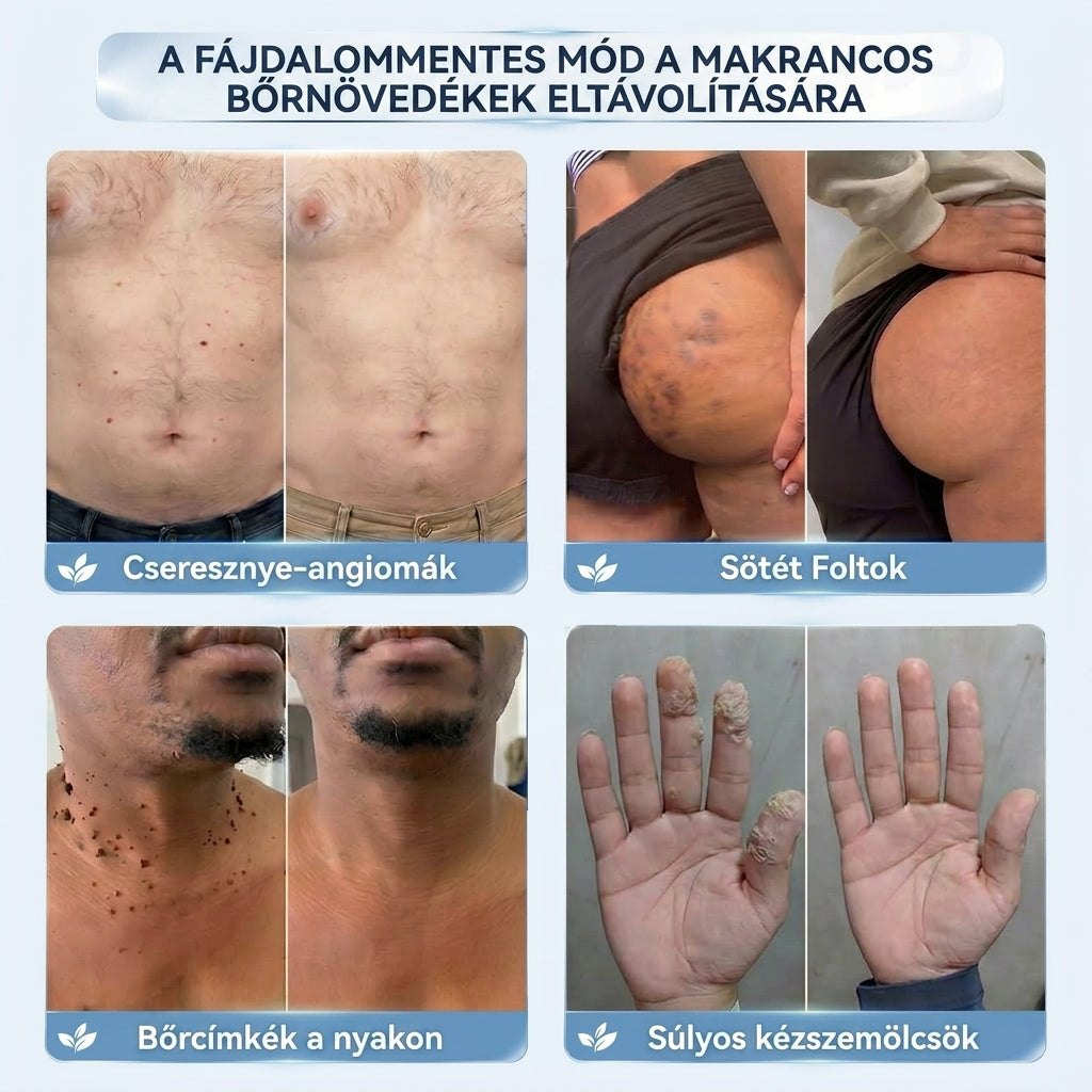 XYL-𝐇𝐢𝐬𝐤𝐢𝐧® 2 az 1-ben fejlett, fájdalommentes és hegmentes bőrmegújító krém – bőrkinövések, szemölcsök és látható bőrhibák ellen