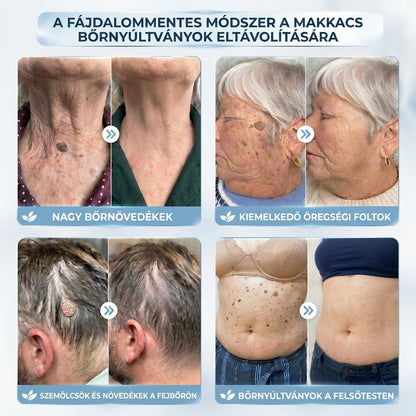 XYL-𝐇𝐢𝐬𝐤𝐢𝐧® 2 az 1-ben fejlett, fájdalommentes és hegmentes bőrmegújító krém – bőrkinövések, szemölcsök és látható bőrhibák ellen